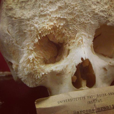 This patient suffered from sarcoma cranii. It’s a cancerous tumor in the bone. It is most commonly seen in children and young adults. 