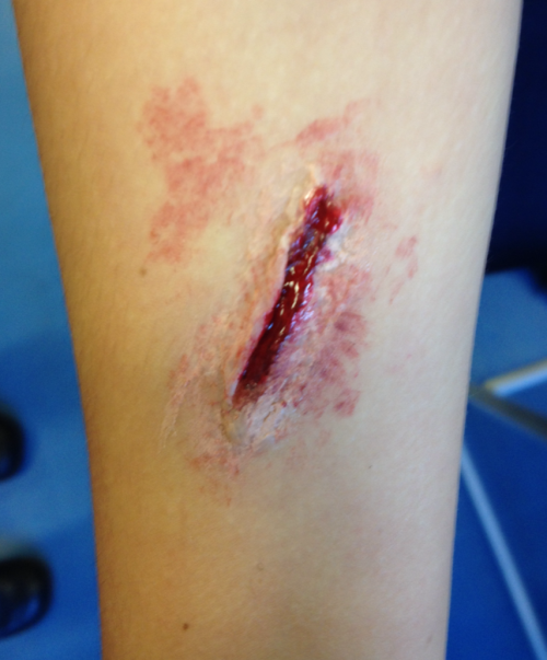 fohrest-tiger:For sixpenceee &amp; her halloween specialHere’s a cool thing I did in drama class with wax and paint that you could do for Halloween! It’s pretty easy, just buy some snazeroo party wax or take it off a candle. Then roll it into a sausage shape, stick it on your wrist and blend the edges into your skin. Add a bit of foundation to the edges to make it your skin colour.Then add a bit of black and red paint to the inside of the cut and some fake blood if you have it. You could use red food coloring!Enjoy!