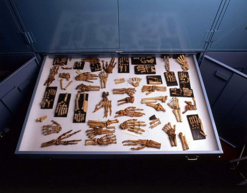 Skeletal specimens of wounded hands of Civil War soldiers. This is located at the National Museum of Health and Medicine. 