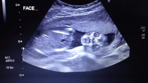The ultrasound belonging to reddit user justme_countrynerd 