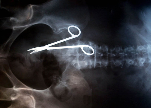 Surgical scissors accidentally forgotten in the body of the patient after the operation. (Source)