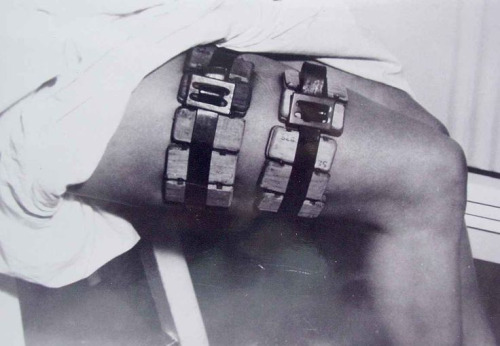  Feeding of lice on the upper part of leg: Cages with typhus carrying lice strapped onto a person’s thigh. During World War II, feeding the lice with human subjects’ blood was the only way to produce a viable typhus vaccine. (Source)
