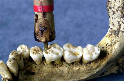 The Indus Valley Civilization has yielded evidence of dentistry being practiced as far back as 7000 BC. This earliest form of dentistry involved curing tooth related disorders with bow drills operated, perhaps, by skilled bead craftsmen. The reconstruction of this ancient form of dentistry showed that the methods used were reliable and effective. Cavities of 3.5 mm depth with concentric grooves indicate use of a drill tool. The age of the teeth has been estimated at 9000 years. (Source) 