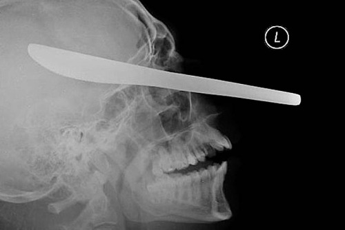 Knife in a patient’s eye(Source)