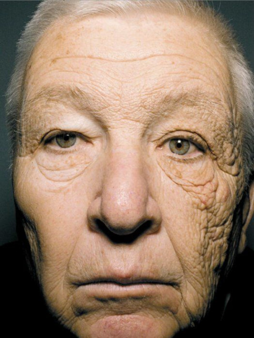 This image from the New England Journal of Medicine shows the effect of sunlight on this truck driver. He’s been exposed to 25 years of direct sunlight thanks to his job but only on the left side of his face. So we get a first-hand view at how much more aged human skin looks when bombarded with sunlight over the years.