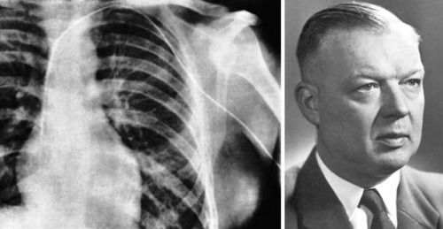 Stabbing His Own HeartWerner Theodor Otto Forssmann, a German surgical trainee in 1929, is famous for an experiment he performed on himself. Without any direction, he put himself under local anesthetic, incised a hole in his arm and pushed a catheter all the way up his limb and shoved it into his heart. He performed the procedure on himself with two feet of cable after which he walked to the X-ray room. He was fired after this stunt, but was awarded the 1956 Nobel Prize for Medicine for developing a procedure that allowed for cardiac catheterization. (Source)